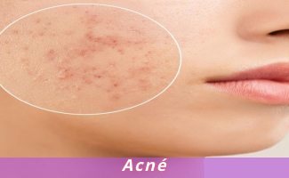 Acné