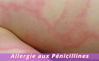Allergie aux Pénicillines