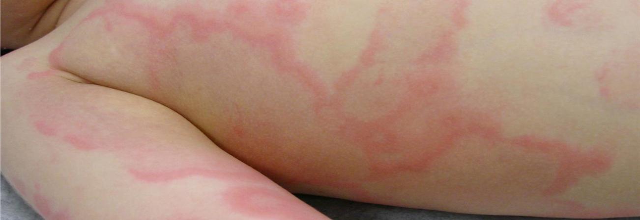 Allergie aux Pénicillines : Qu'est-ce que c'est ?