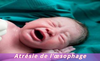 Atrésie de l'œsophage