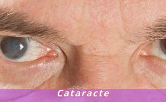 Cataracte