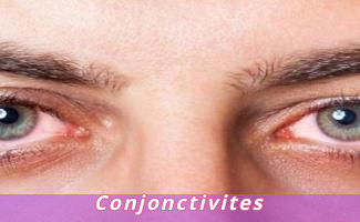 Conjonctivites