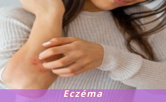 Eczéma
