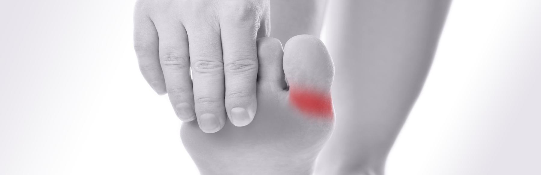 Goutte : définition, causes, symptômes, traitement