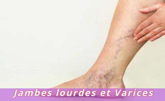 Jambes lourdes et Varices