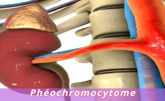 Phéochromocytome