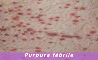 Purpura fébrile