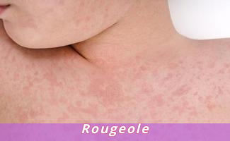 Rougeole