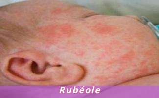 Rubéole