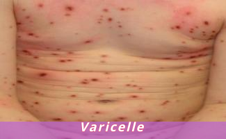 Varicelle