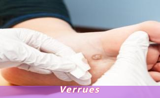 Verrues