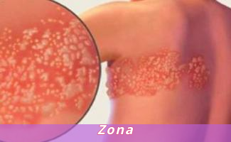 Zona